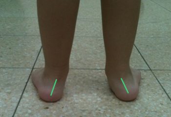 פרונציה של כף הרגל, לקות שאורטופדים לעיתים מגדירים כ- "פלטפוס גמיש".
