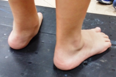פלטפוס ברגל, כף רגל שטוחה בילדים. ילד בן 7 בעת אבחון פלטפוס במוטוריקל