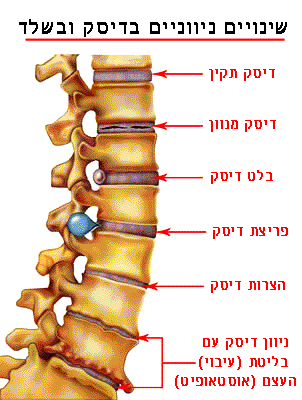 המחשת שינויים ניווניים שכיחים בעמוד השדרה, על רקע יציבה לקויה כדוגמת קיפוזיס מוגבר או היפר לורדוזיס
