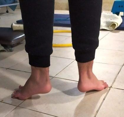הליכה על קצות האצבעות עקב גיד אכילס קצר/ קיצור בגיד אכילס (משמעותי/ חמור) בעת אבחון במוטוריקל.